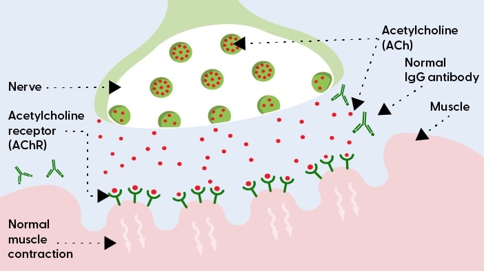 The neuromuscular junction without MG