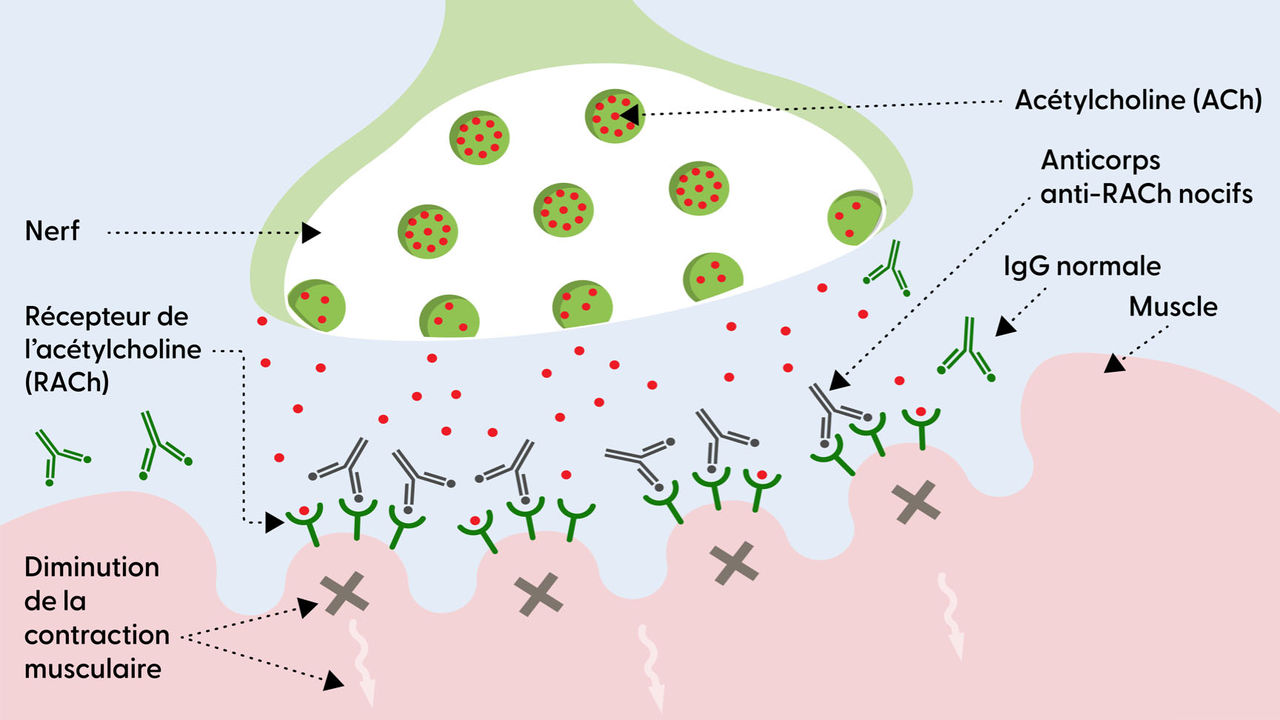 La jonction neuromusculaire en présence de MG